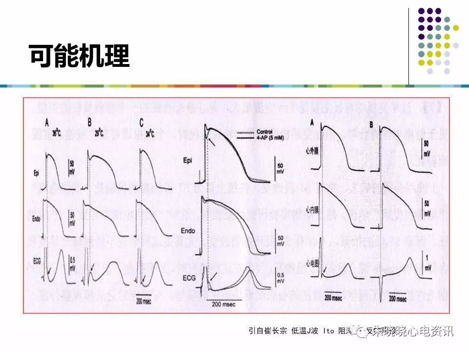 特殊心电图现象在急诊中的快速识别与处理，赶紧收藏！