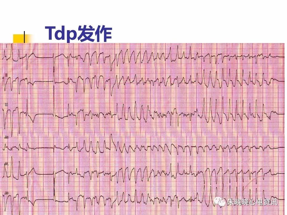 特殊心电图现象在急诊中的快速识别与处理，赶紧收藏！