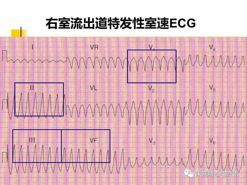 特殊心电图现象在急诊中的快速识别与处理，赶紧收藏！