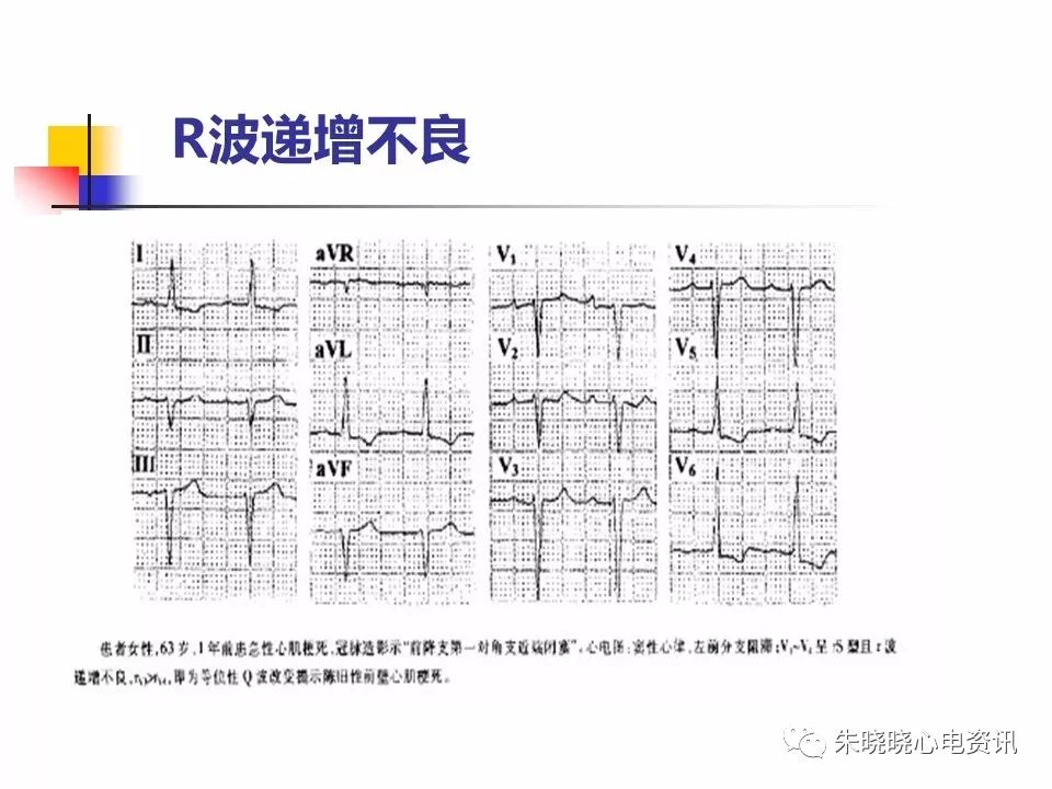 特殊心电图现象在急诊中的快速识别与处理，赶紧收藏！