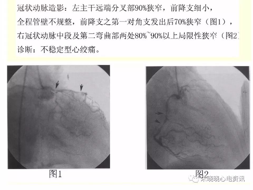 特殊心电图现象在急诊中的快速识别与处理，赶紧收藏！