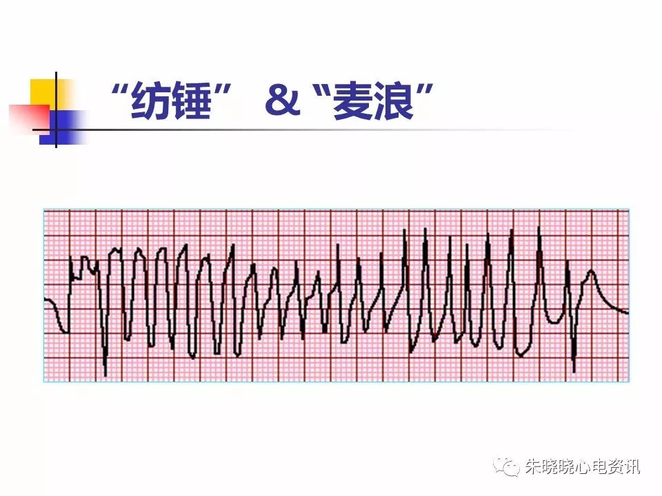 特殊心电图现象在急诊中的快速识别与处理，赶紧收藏！
