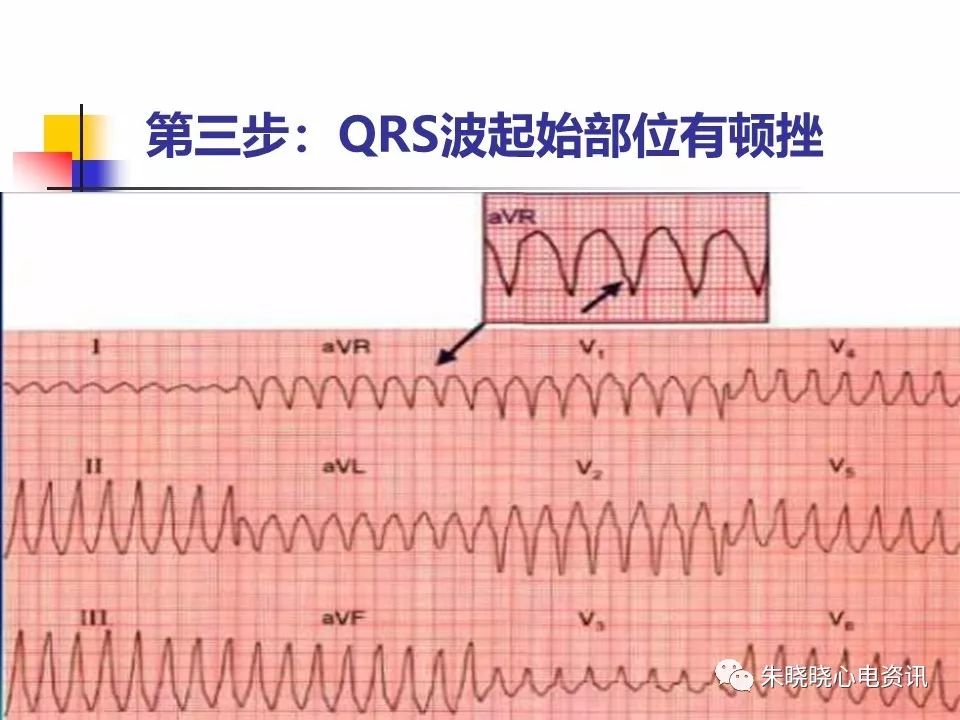 特殊心电图现象在急诊中的快速识别与处理，赶紧收藏！