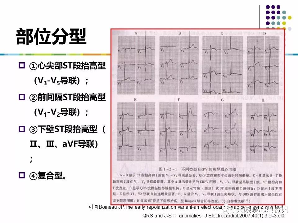 特殊心电图现象在急诊中的快速识别与处理，赶紧收藏！