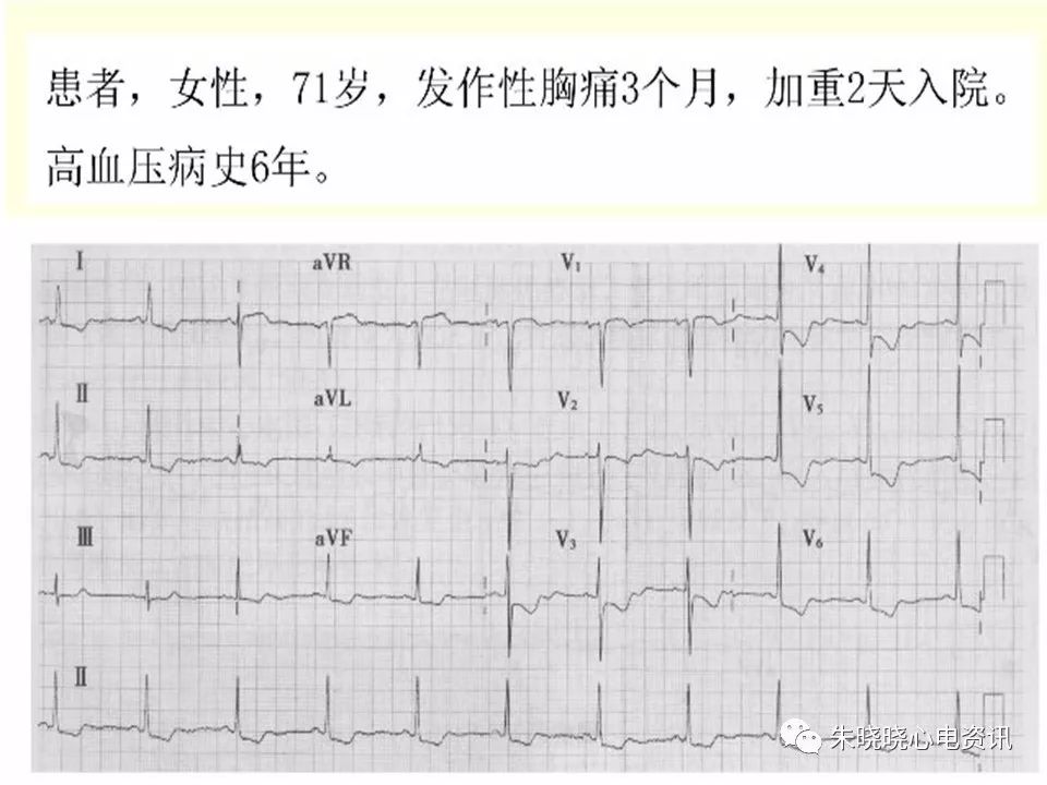 特殊心电图现象在急诊中的快速识别与处理，赶紧收藏！