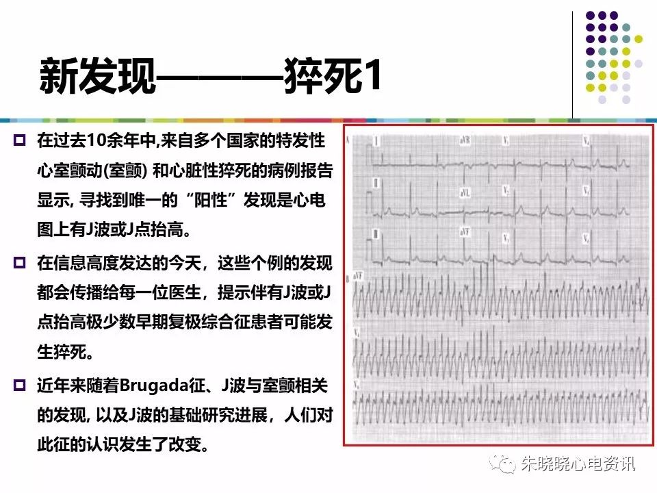 特殊心电图现象在急诊中的快速识别与处理，赶紧收藏！