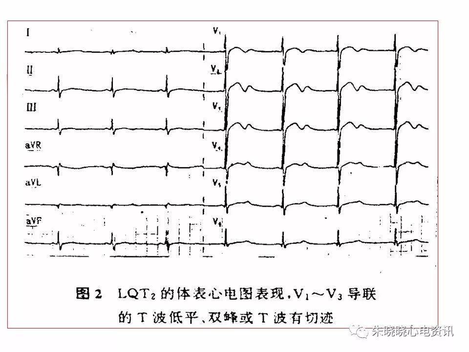 特殊心电图现象在急诊中的快速识别与处理，赶紧收藏！