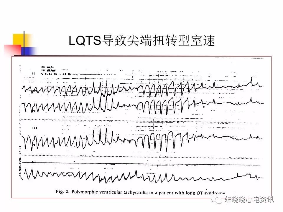 特殊心电图现象在急诊中的快速识别与处理，赶紧收藏！