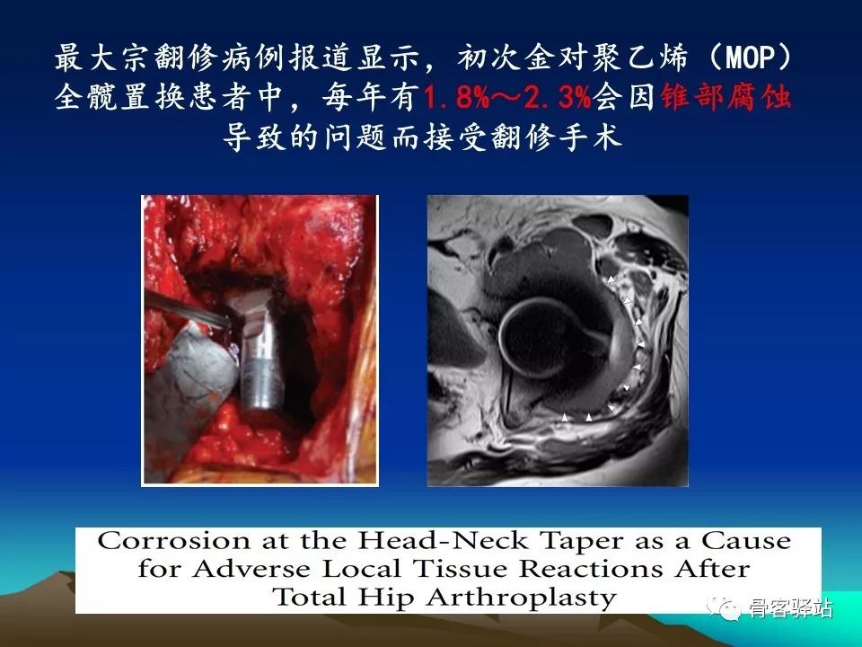 如何延长人工髋关节的使用寿命？本文值得一看！