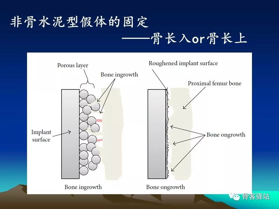 如何延长人工髋关节的使用寿命？本文值得一看！