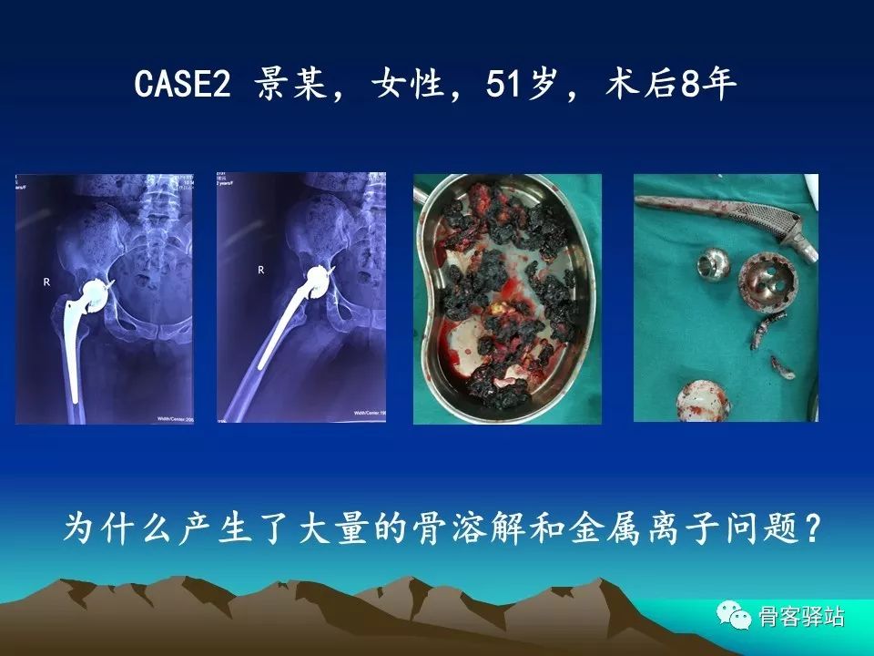 如何延长人工髋关节的使用寿命？本文值得一看！