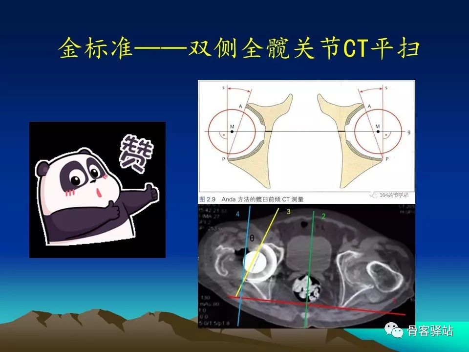 一文详解：全髋关节置换术后的X线评估