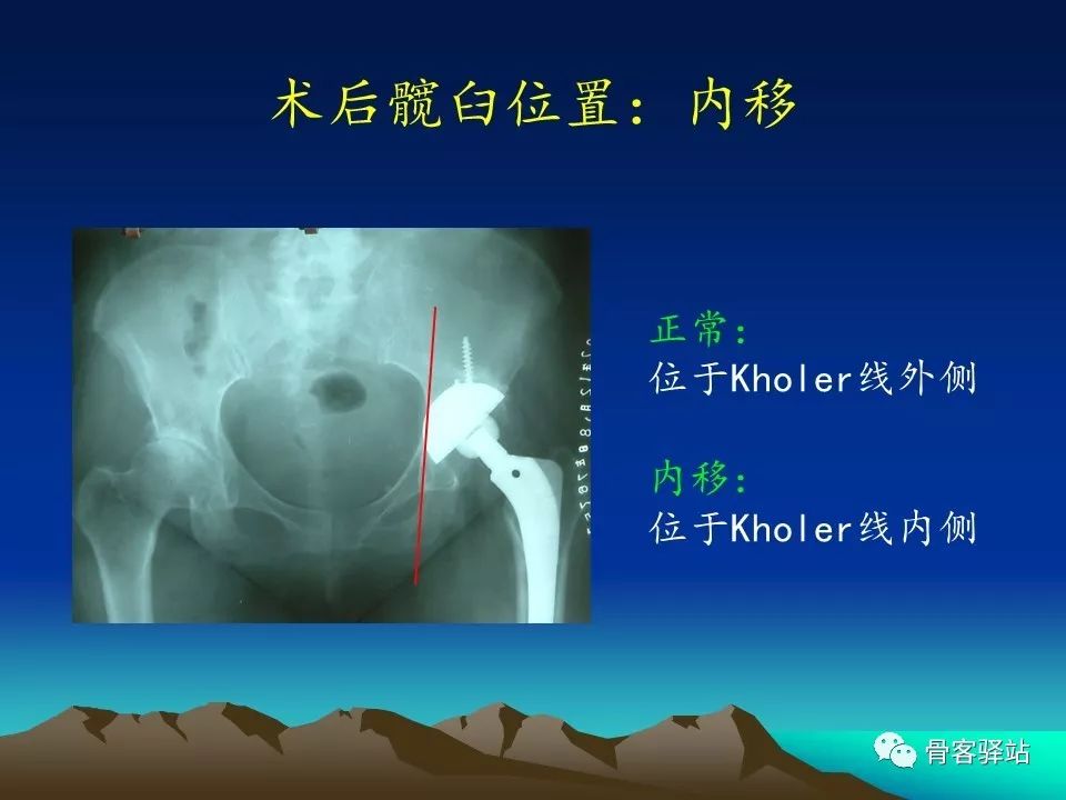 一文详解：全髋关节置换术后的X线评估