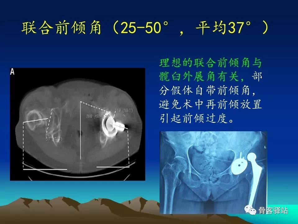 一文详解：全髋关节置换术后的X线评估