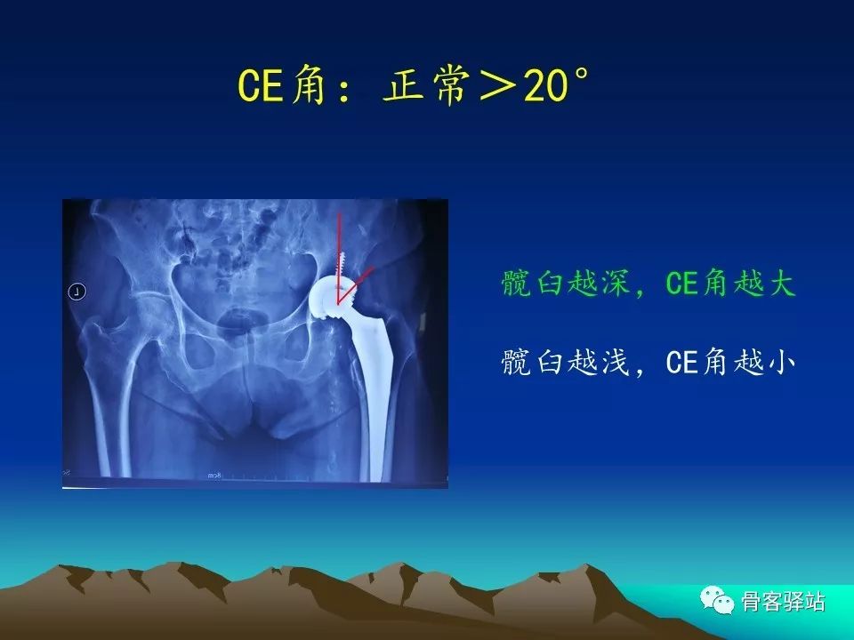 一文详解：全髋关节置换术后的X线评估