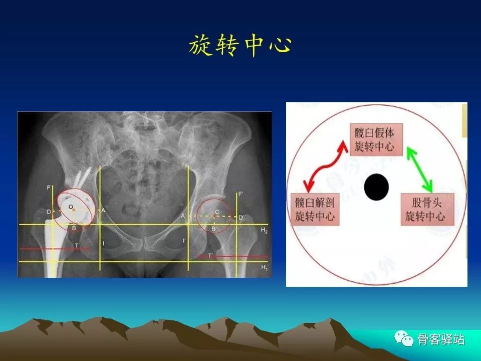 一文详解：全髋关节置换术后的X线评估