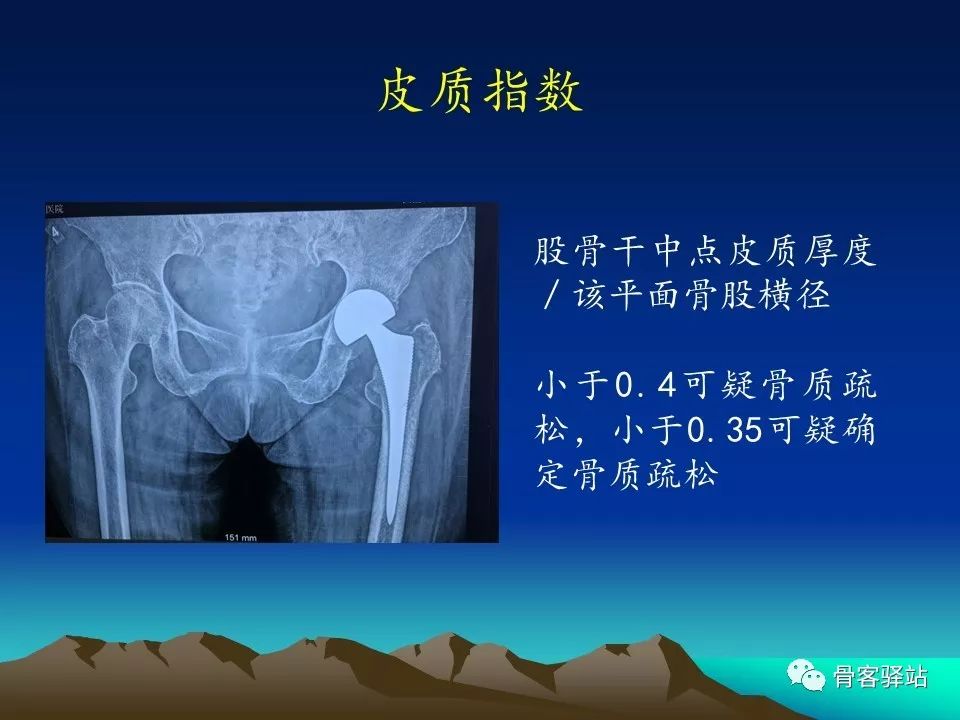 一文详解：全髋关节置换术后的X线评估