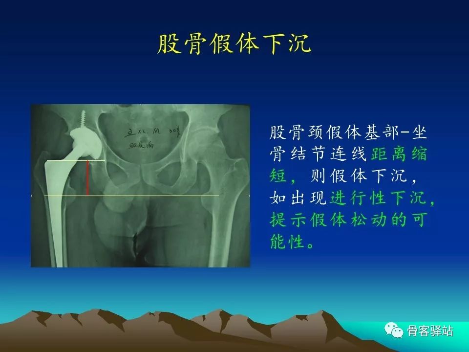 一文详解：全髋关节置换术后的X线评估