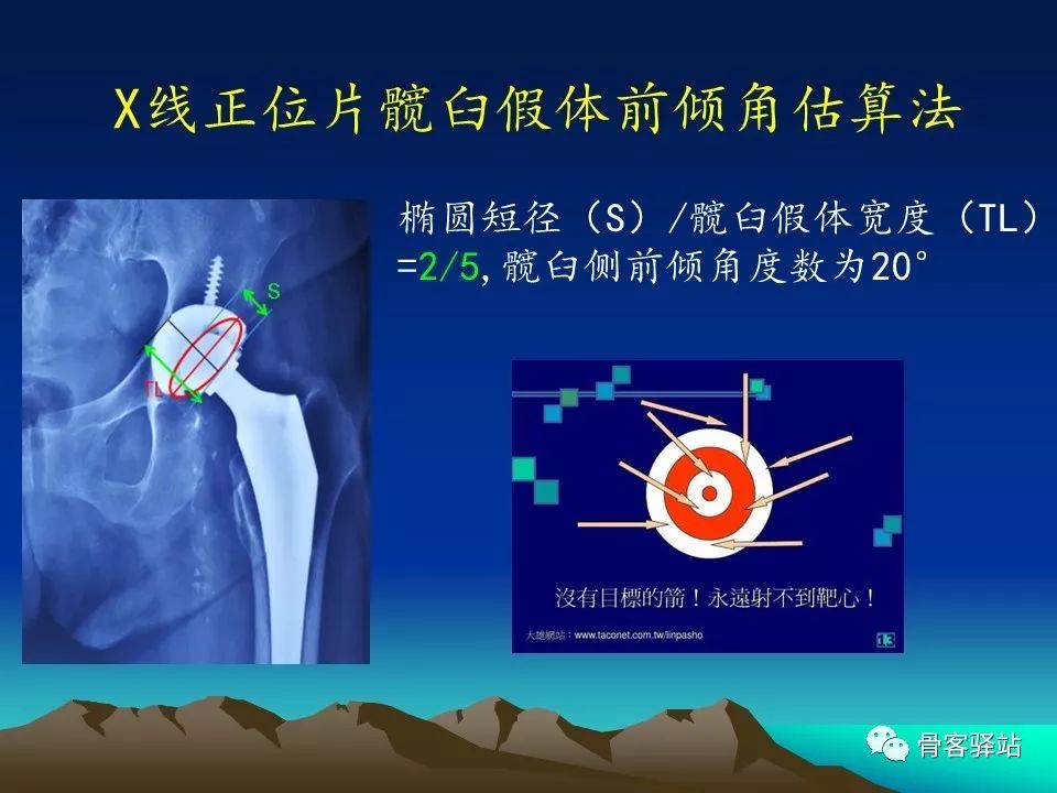 一文详解：全髋关节置换术后的X线评估