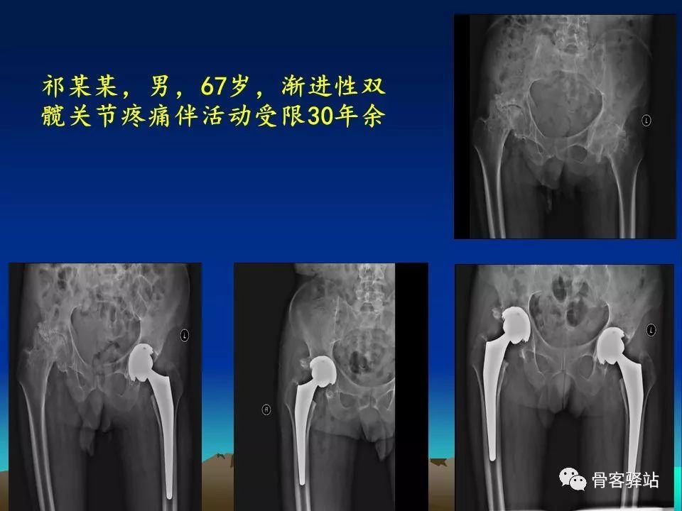 一文详解：强直髋THA手术策略