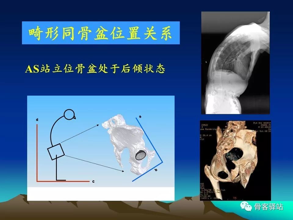 强直髋THA手术策略，值得一看！