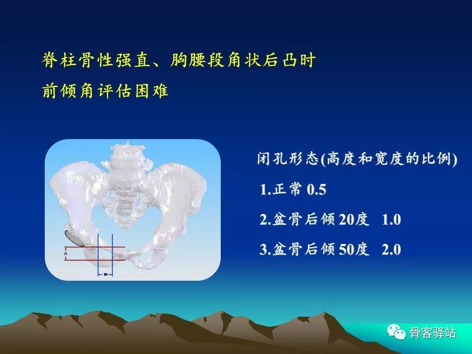 强直髋THA手术策略，值得一看！