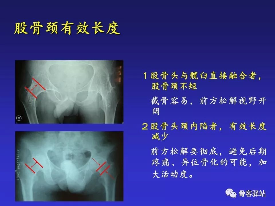 强直髋THA手术策略，值得一看！