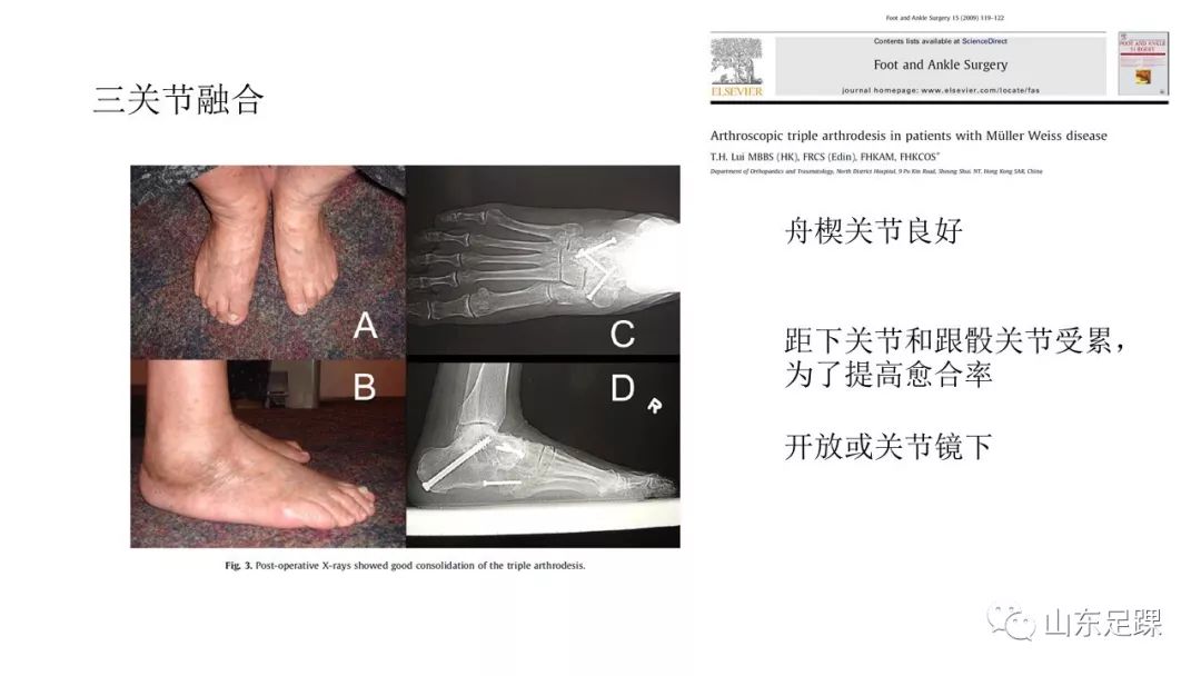 Muller-Weiss病如何诊治？看看这篇！