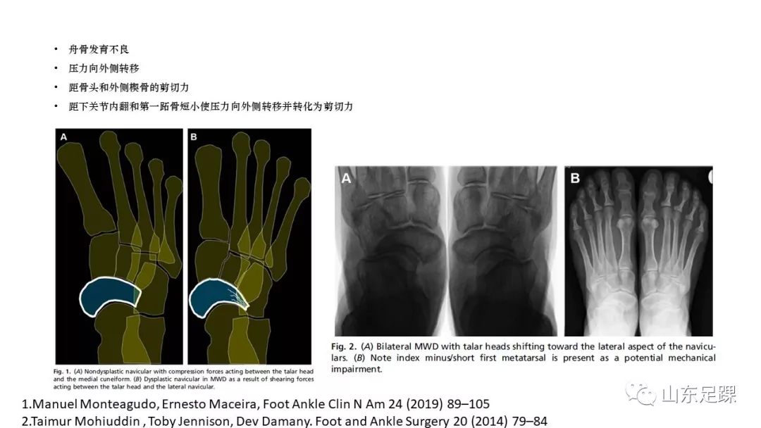 Muller-Weiss病如何诊治？看看这篇！