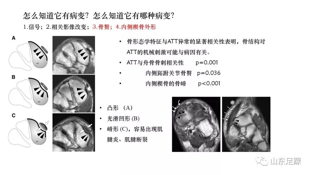 胫前肌腱病变的诊治，值得一看！