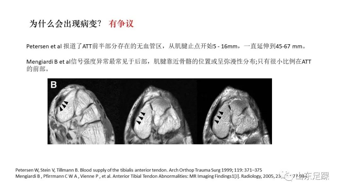 胫前肌腱病变的诊治，值得一看！