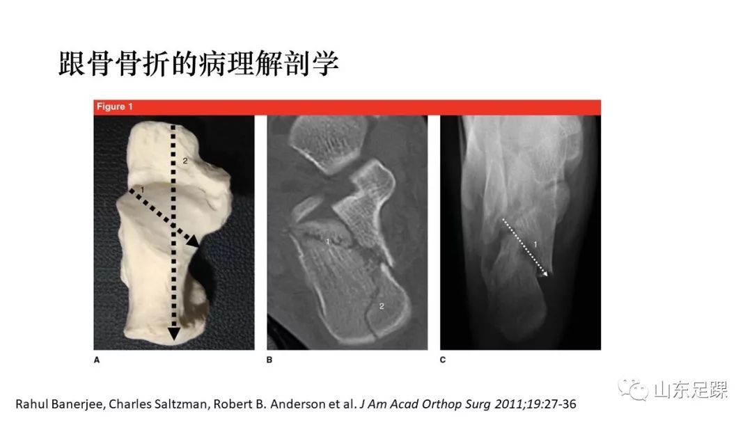 一文详解：跟骨骨折畸形愈合的治疗