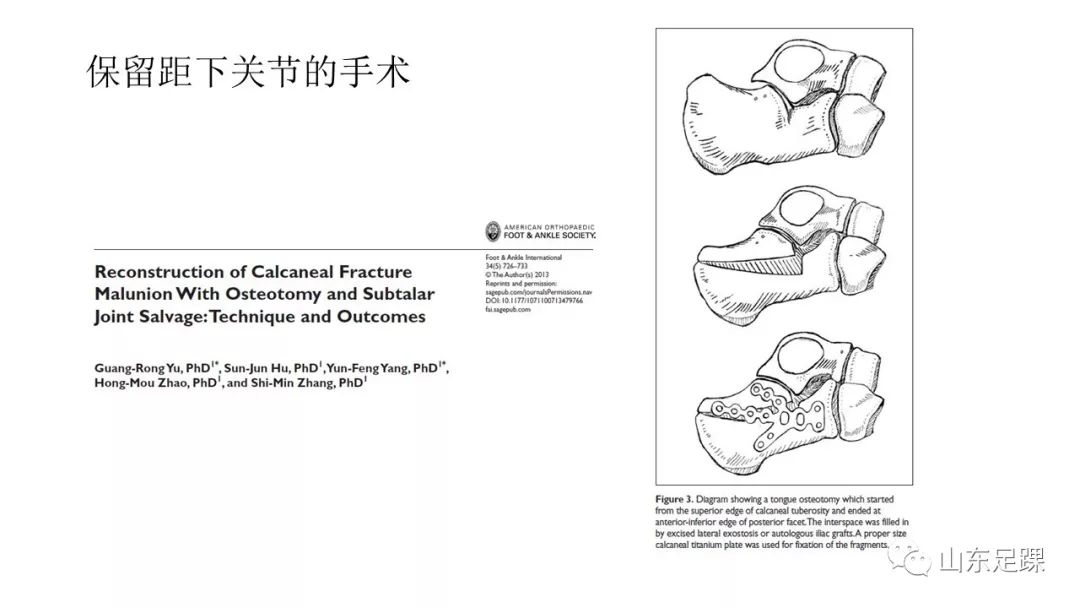 一文详解：跟骨骨折畸形愈合的治疗