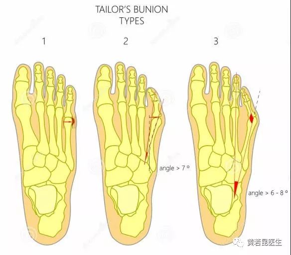 裁缝趾的分型与手术治疗策略