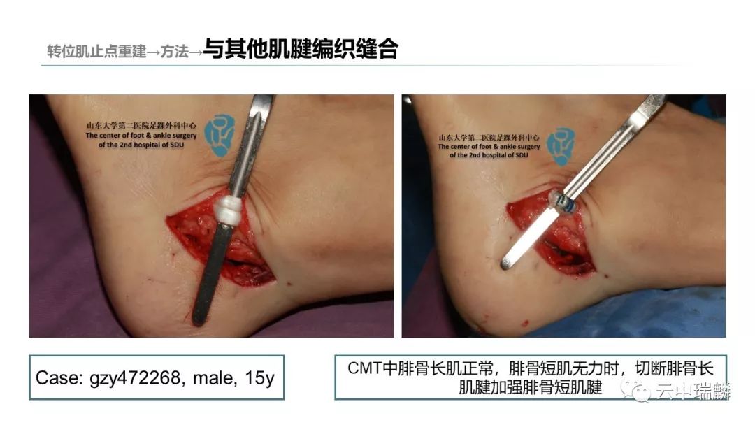 一文掌握：肌腱转位的原则及手术要点