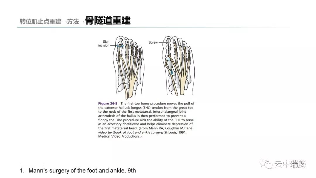 一文掌握：肌腱转位的原则及手术要点