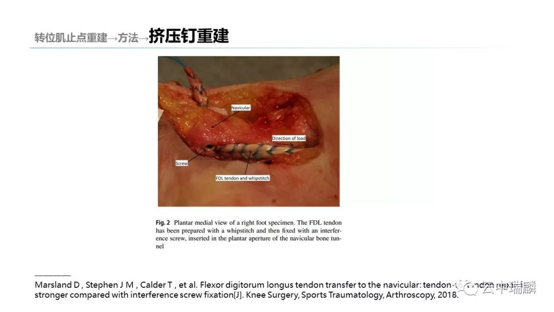 一文掌握：肌腱转位的原则及手术要点