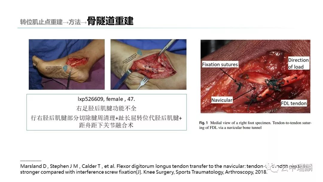 一文掌握：肌腱转位的原则及手术要点