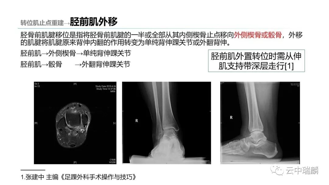 肌腱转位的原则及手术要点，详细解析！