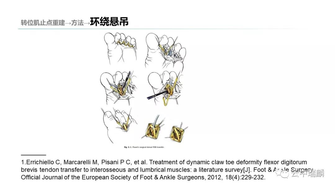 一文掌握：肌腱转位的原则及手术要点