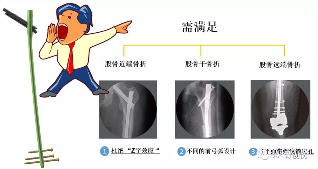 什么是股骨髓内钉“Z”字效应？一文详解！