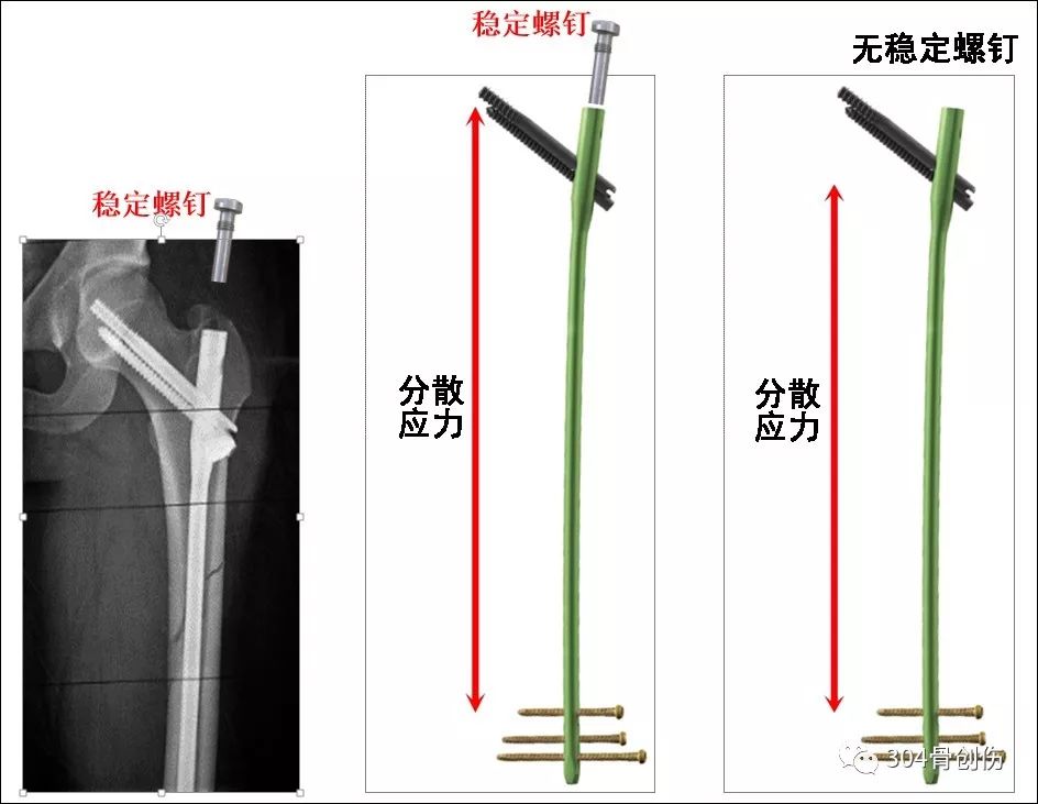 什么是股骨髓内钉“Z”字效应？一文详解！