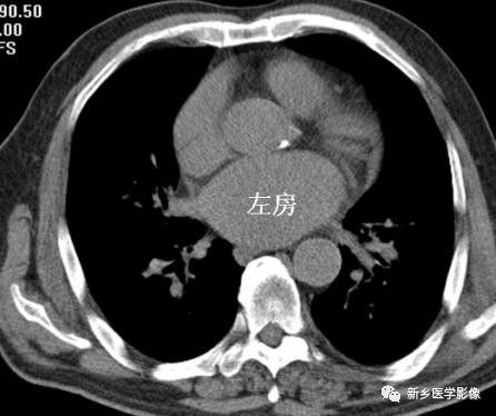 循环系统4种基本病变的影像学表现