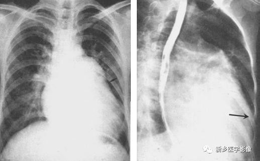 循环系统4种基本病变的影像学表现