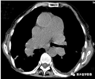 循环系统4种基本病变的影像学表现