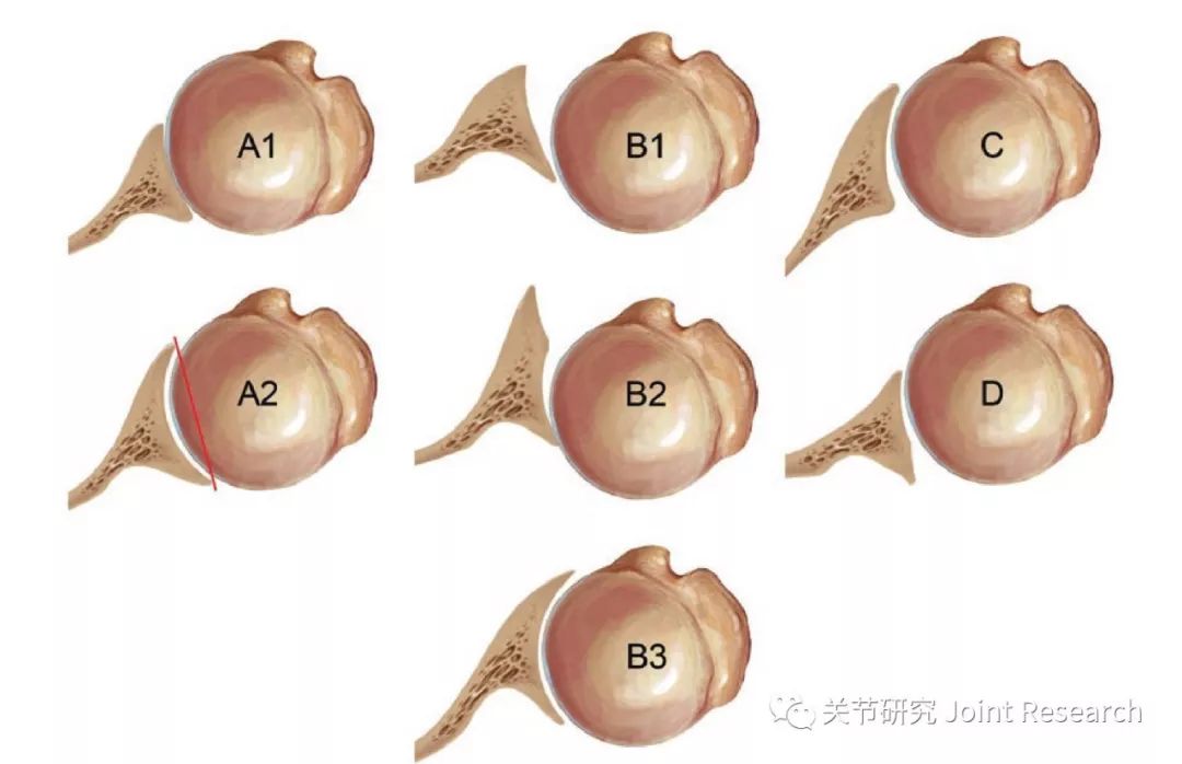 想做肩关节置换吗？先来盘点一下肩盂的分型