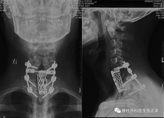 椎动脉：脊柱外科医生最头痛的血管