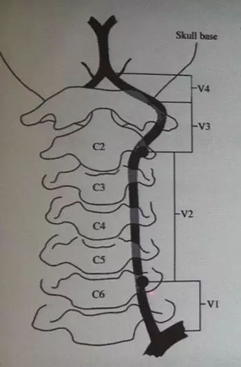 椎动脉：脊柱外科医生最头痛的血管