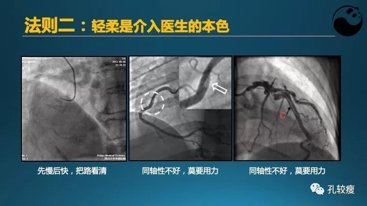 步步为营掌握冠状动脉造影【一】：解剖-体位-安全法则