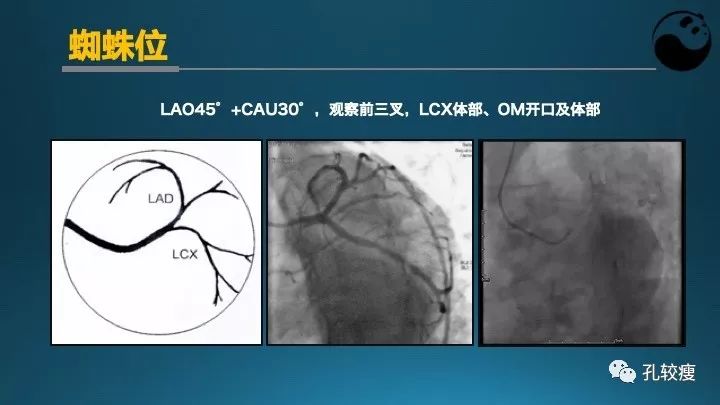 步步为营掌握冠状动脉造影【一】：解剖-体位-安全法则